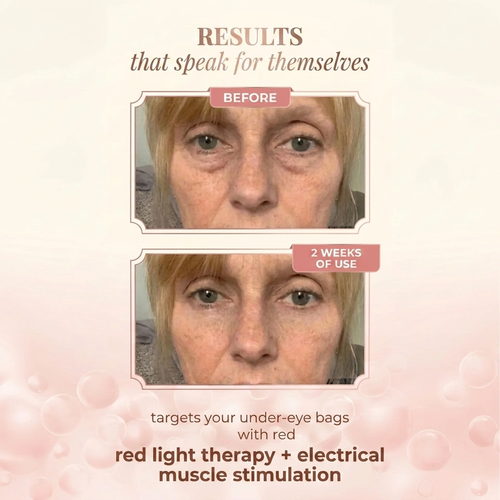 Red Light Therapy — Under Eye Skincare + EMS To Erase Eye Bags