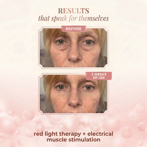 Red Light Therapy — Under Eye Skincare + EMS To Erase Eye Bags